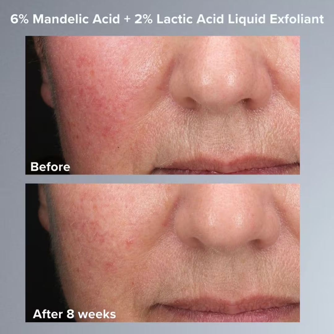 PAULA'S CHOICE - SKIN PERFECTING 6% Mandelic Acid + 2% Lactic Acid AHA - Exfoliant AHA - 30 ML